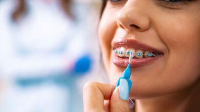 Achieving a Confident Smile: The Importance of Carle Place Braces