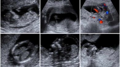 Fetal Doppler Ultrasound Equipment
