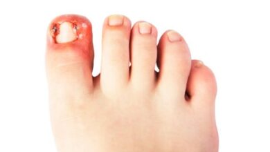 Best Private Treatment of Ingrown Toenail