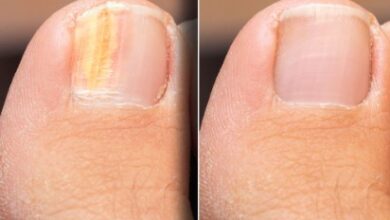 Where to Get Laser Toenail Treatment in Scottsdale