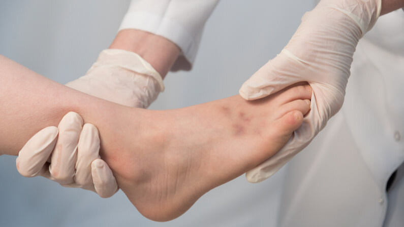 What Are the Most Common Causes of Ankle Sprains