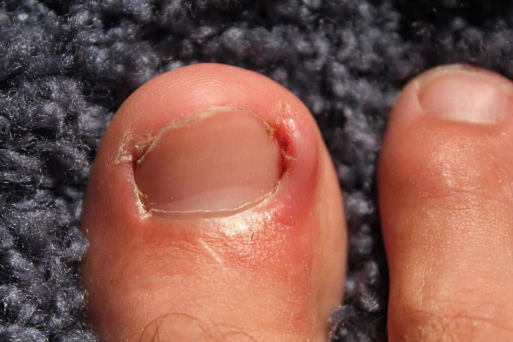 How Long Do Toenail Removal Healing Stages Take